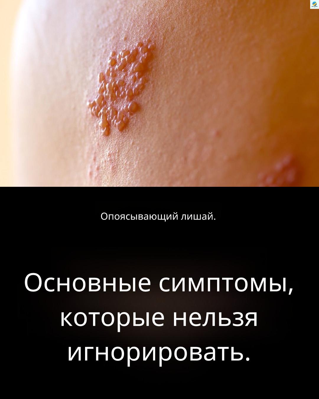 誰最容易受到開髮帶狀皰疹的風險？