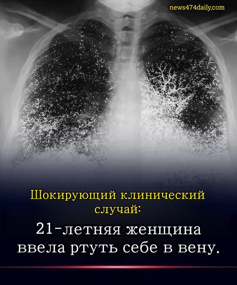 案例：血液中的汞注入