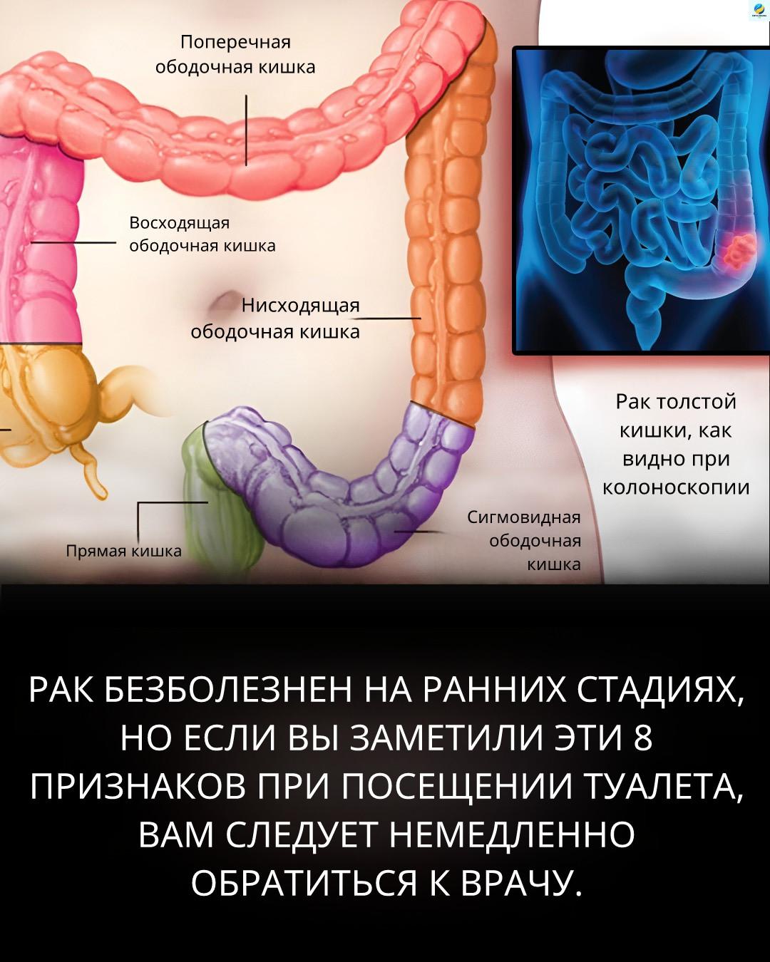 為什麼早期檢測到結腸癌如此重要