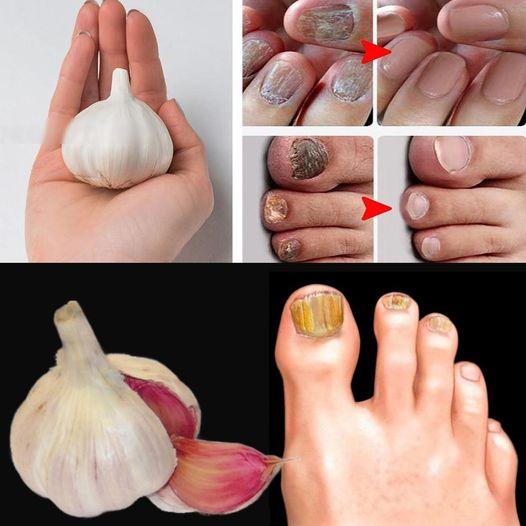 如何使用大蒜治療指甲真菌